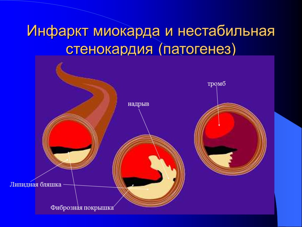 Инфаркт миокарда и нестабильная стенокардия (патогенез) Липидная бляшка Фиброзная покрышка надрыв тромб